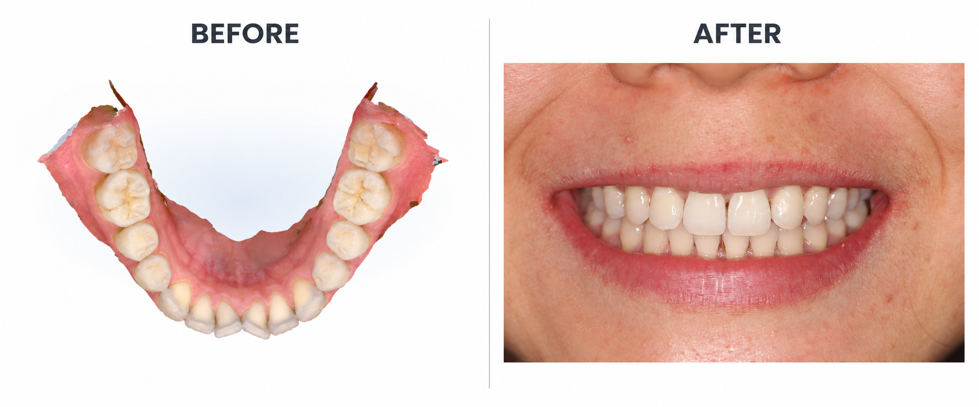 Invisalign Patient Result 3, before and after Invisalign treatment