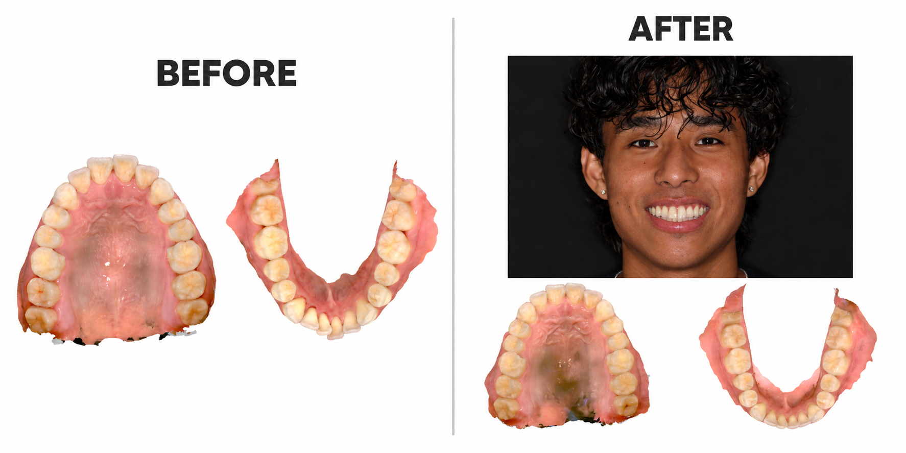 Invisalign Patient Result 2, before and after Invisalign treatment