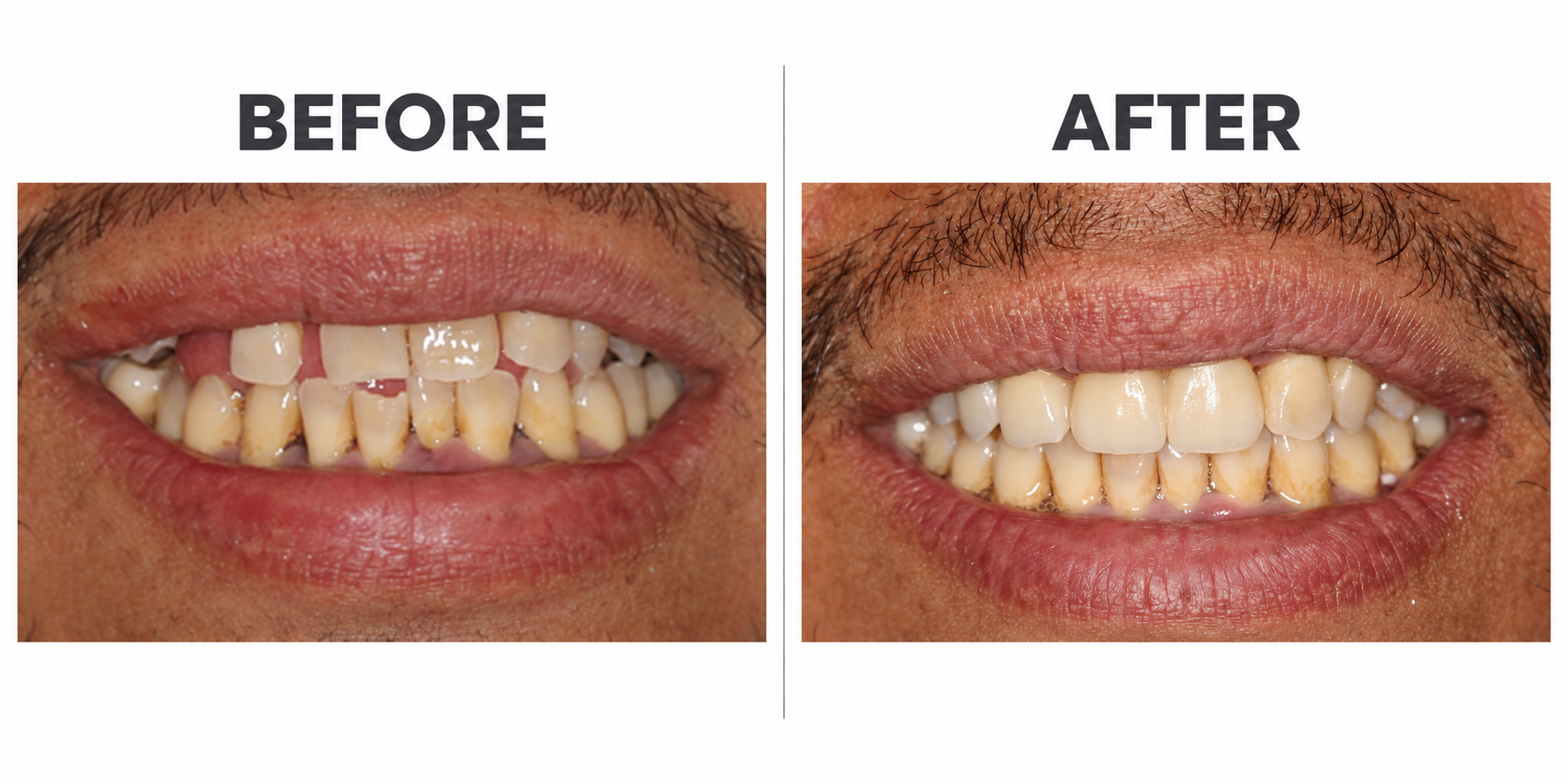 Invisalign Patient Result 1, before and after Invisalign treatment